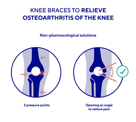 Knee braces to relieve oesteoaethritis of the knee