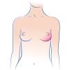 Breast reconstruction